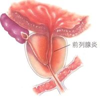 尿道炎